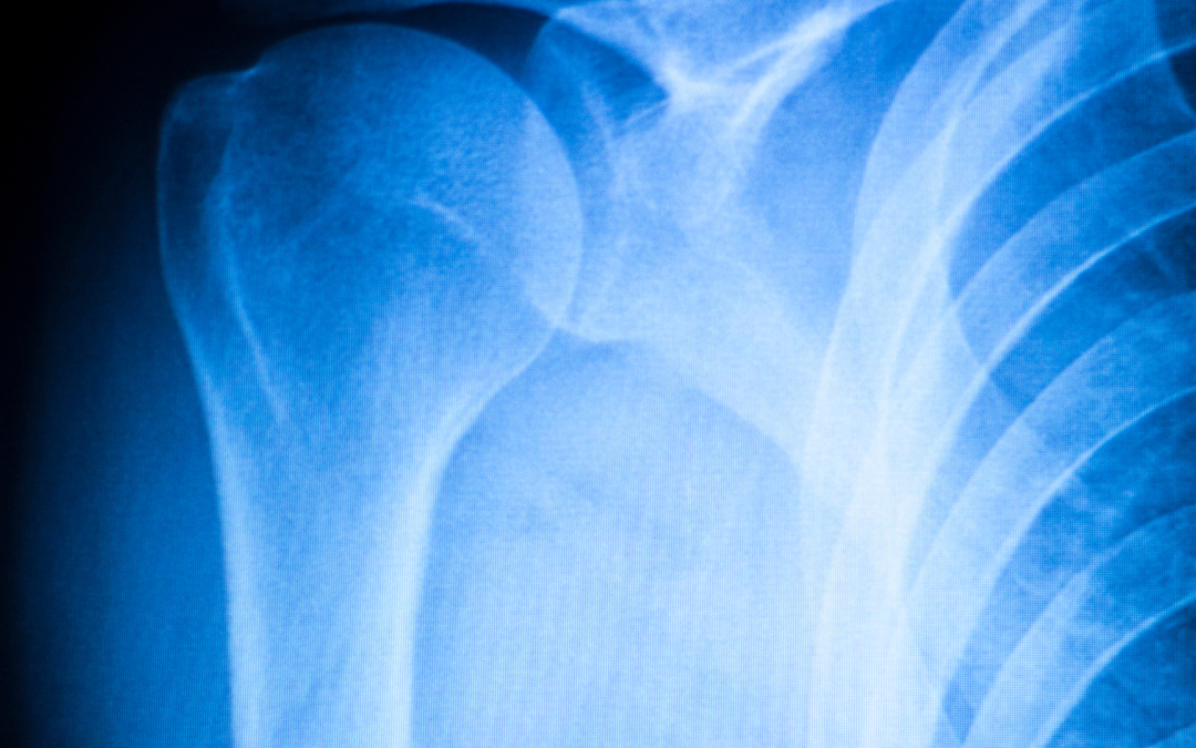 What is a Separated Shoulder?
