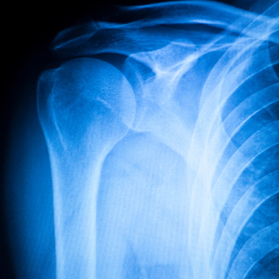 what-is-a-separated-shoulder-compete-sports-performance